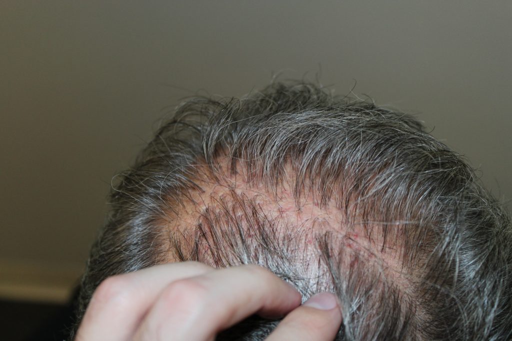 Hair Transplant Plugs Learn About Hair Plug Surgery Treatment